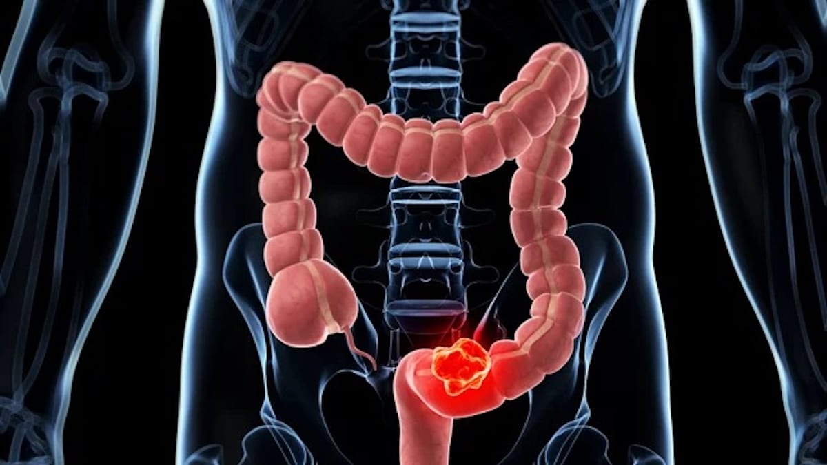 4 symptômes du cancer du côlon que vous ne devriez jamais ignorer