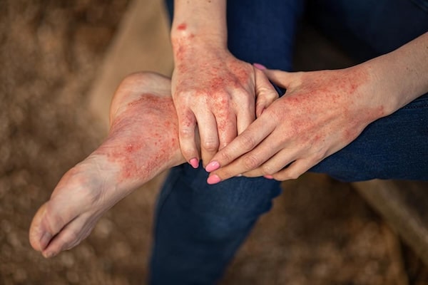 Dermatite de stase : causes, symptômes et traitement