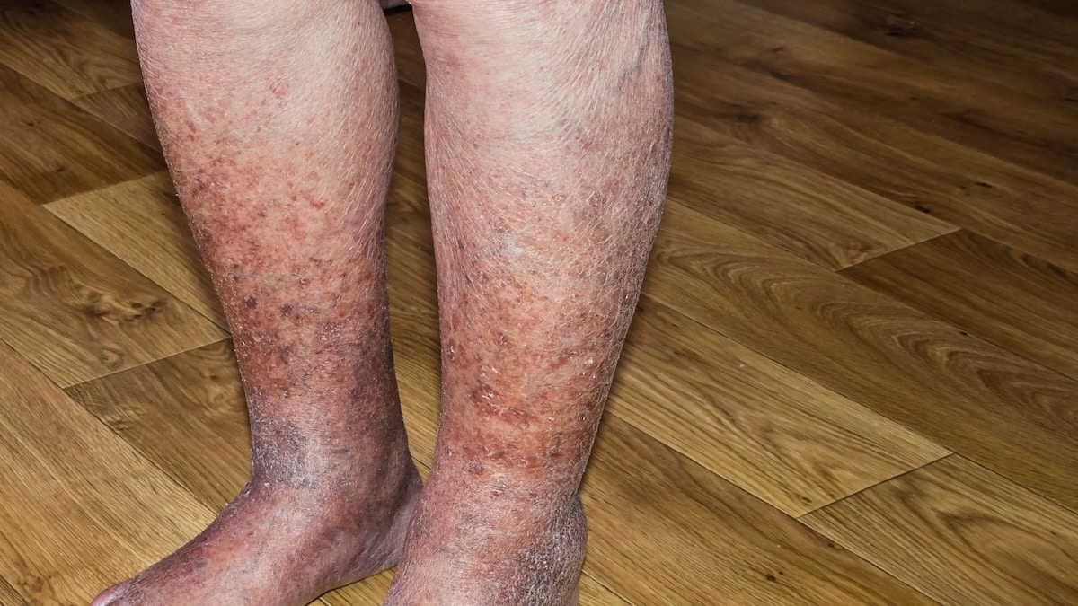 Dermatite de stase : causes, symptômes et traitement
