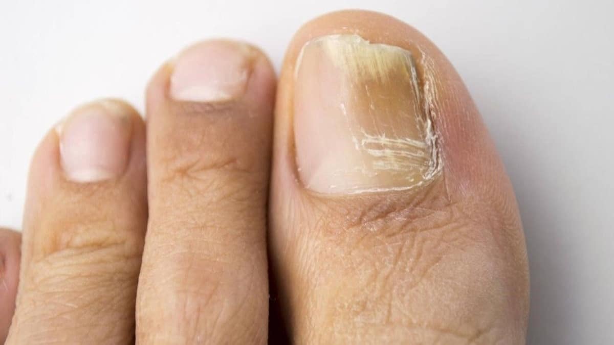 Ongles épais : raisons, symptômes et traitements possibles