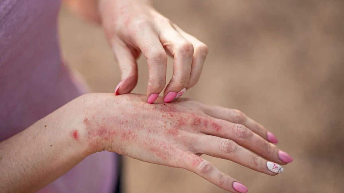 Trois infection cutanées atypiques souvent prises pour des verrues