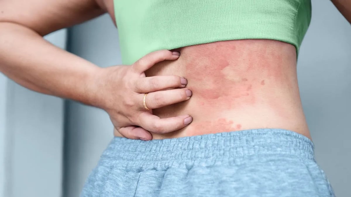 Allergie au stress : lorsque les émotions provoquent une réaction surprenante