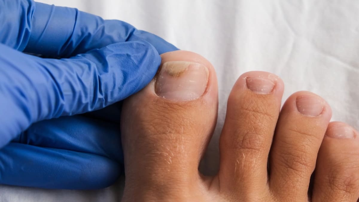 Astuces maison pour soigner les callosités et les mycoses des pieds