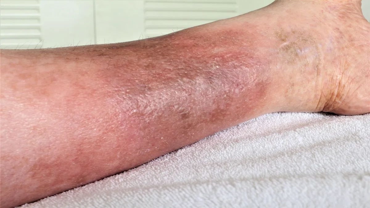 Changement de couleur des jambes : 5 causes courantes à connaître