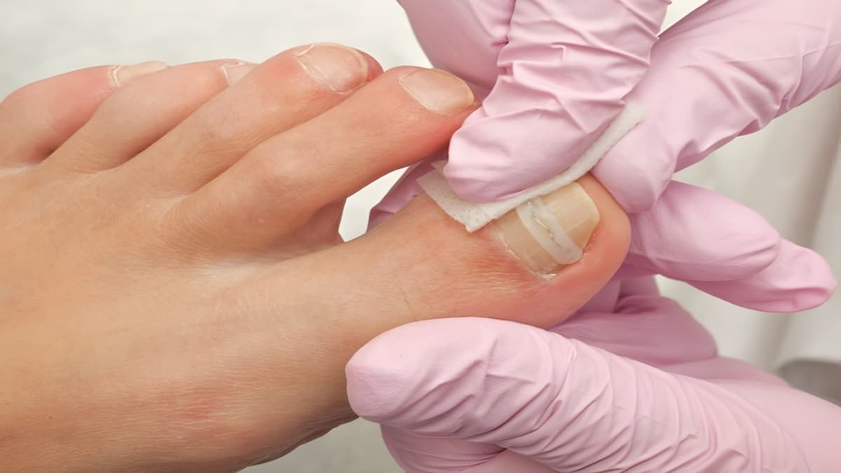 Épaississement des ongles : comprendre les causes et agir