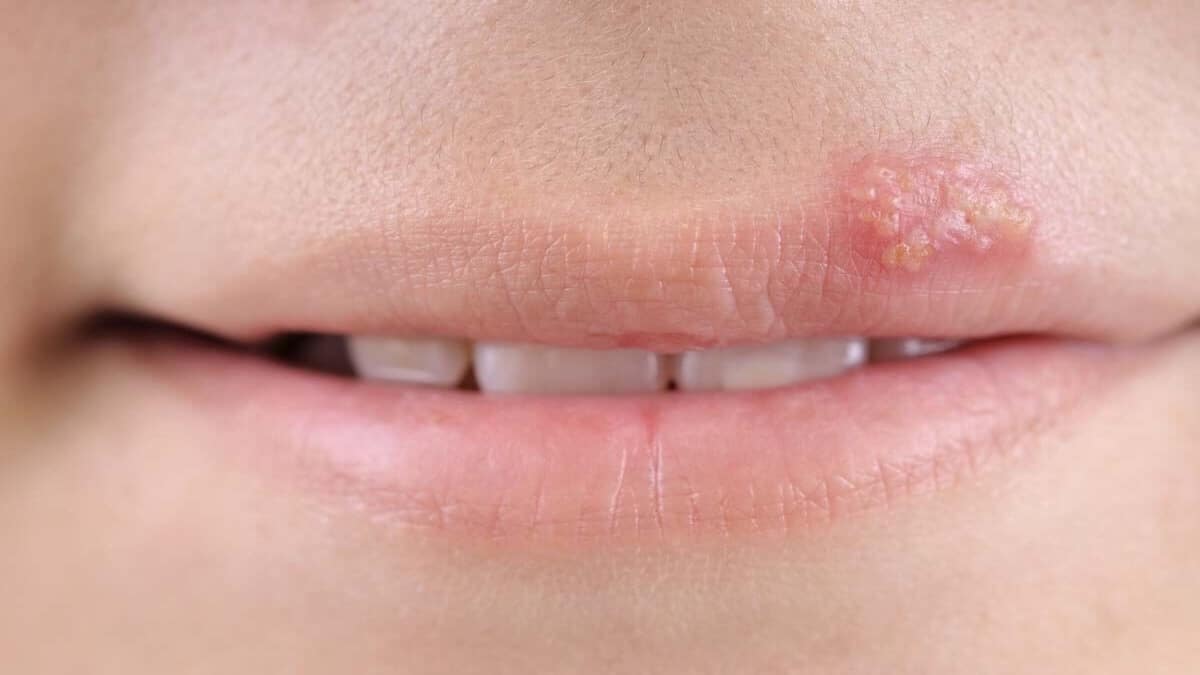 Érythème polymorphe étendu lié à une infection par le virus de l'herpès simplex