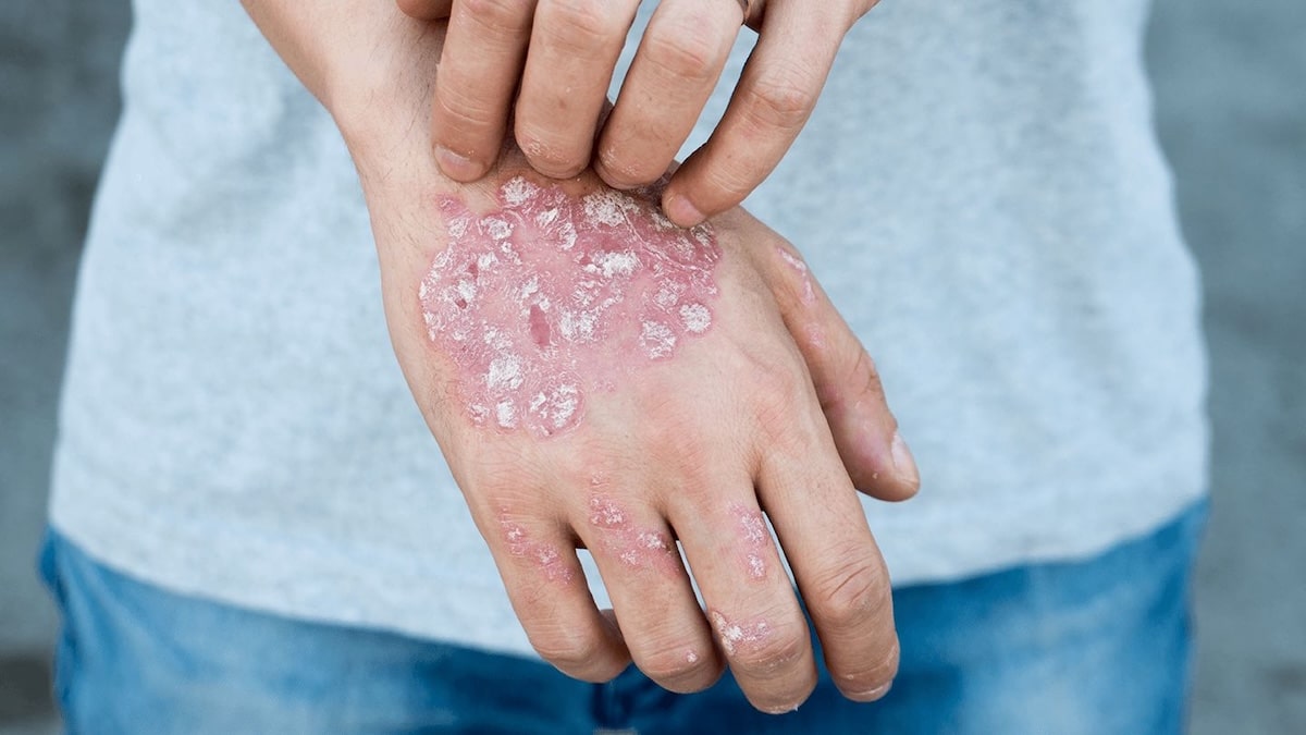 Psoriasis pustuleux : les signes à surveiller et les options de traitement