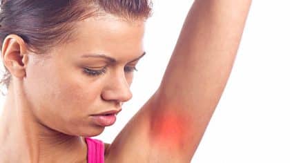 Hidradénite suppurée : symptômes et causes