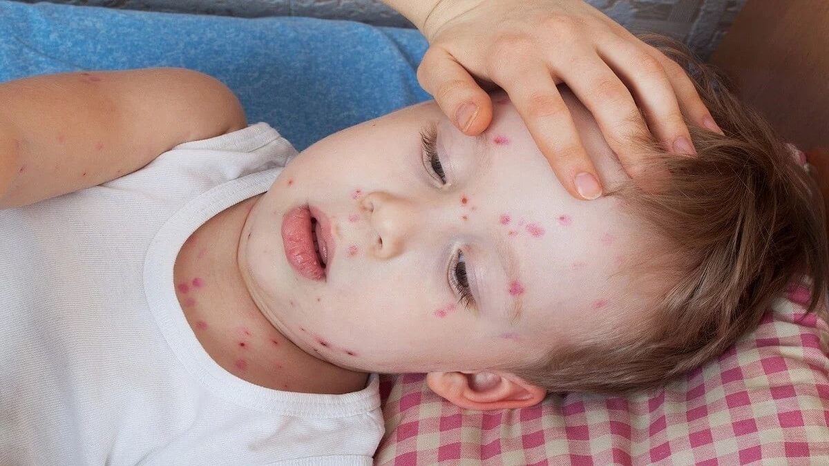 Mon enfant souffre d'urticaire : est-ce la même chose qu'une allergie ?