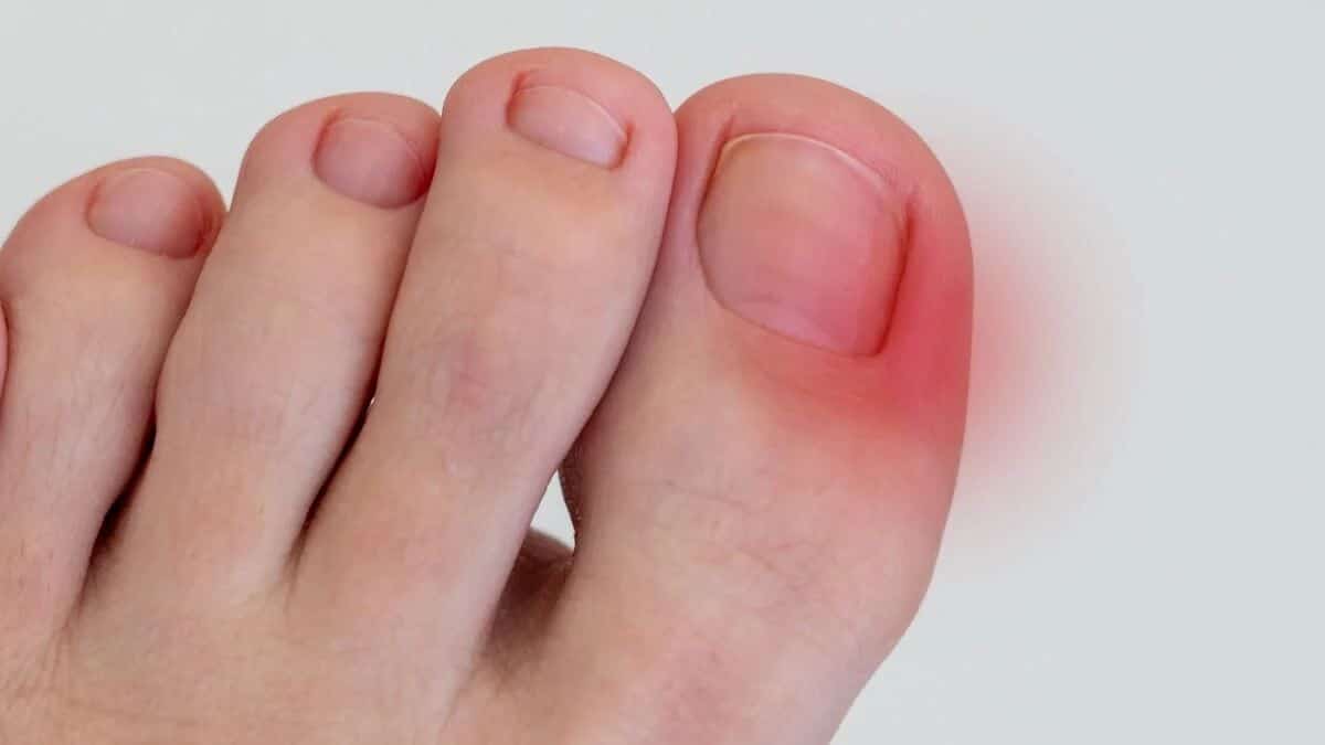 Ongles enfoncés dans la peau : causes et solutions