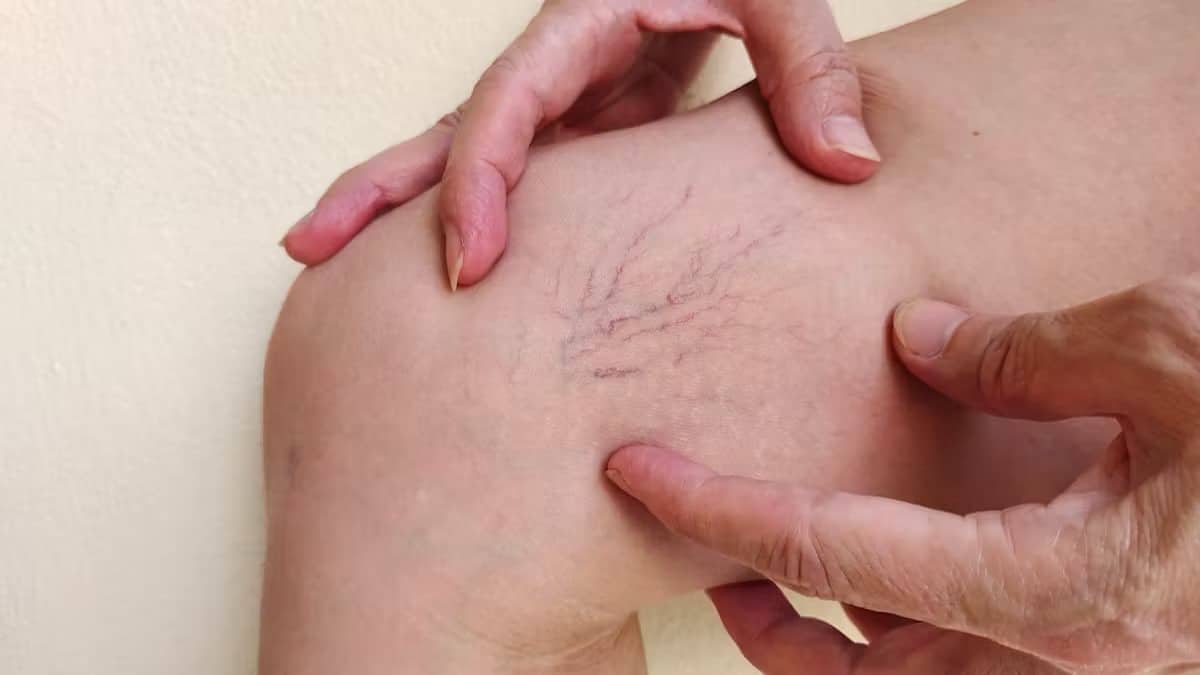 Pourquoi vos veines visibles peuvent en dire long sur votre santé