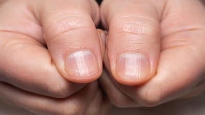 Pourquoi y a-t-il des lignes et des rainures sur mes ongles ?
