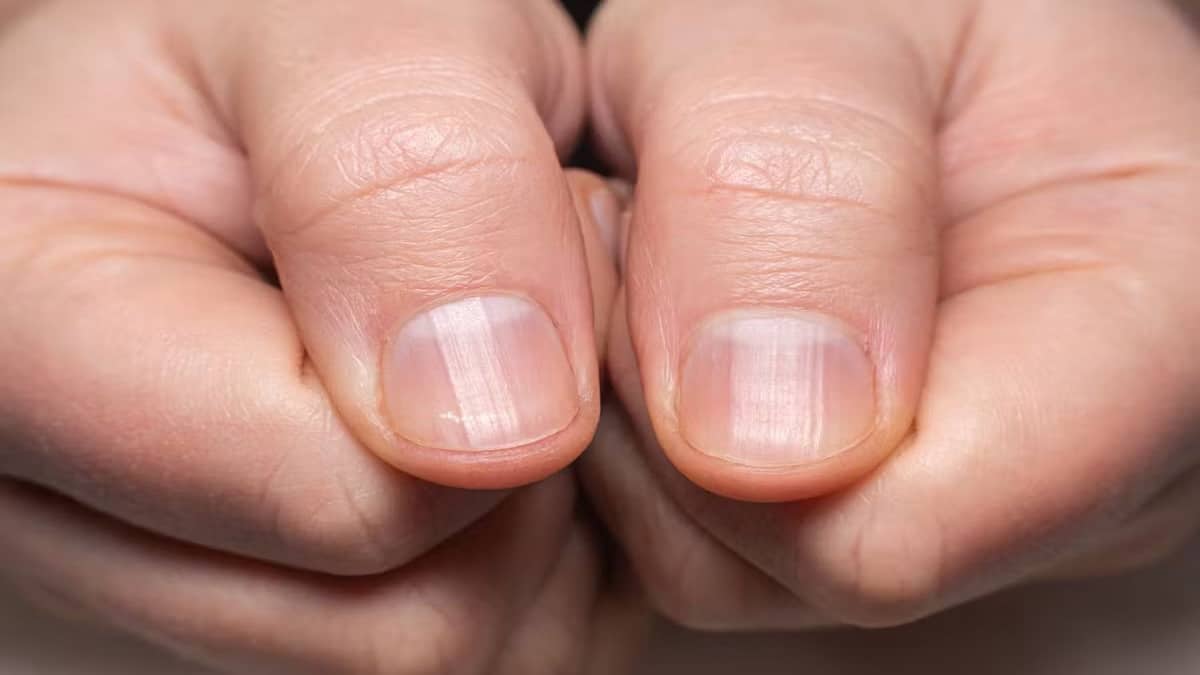 Pourquoi y a-t-il des lignes et des rainures sur mes ongles ?