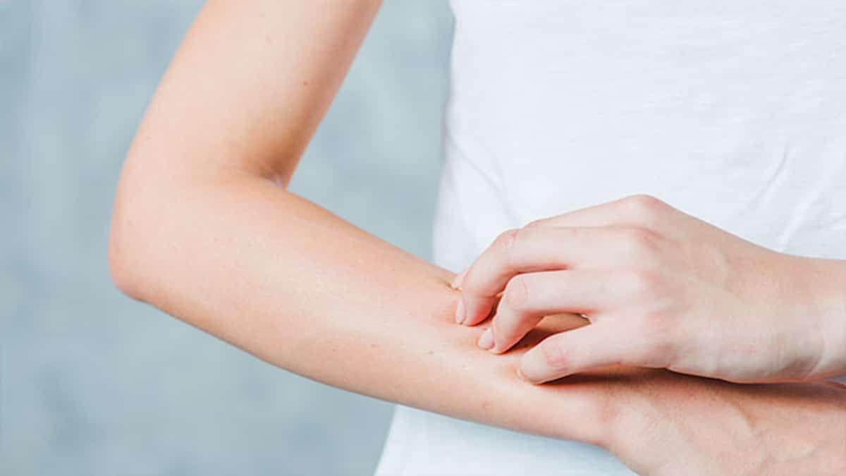 Psoriasis – Symptômes, causes et solutions