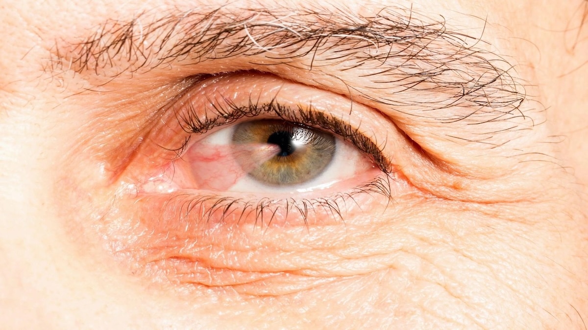 Ptérygion (Yeux Charnus) : causes, symptômes et options de traitement