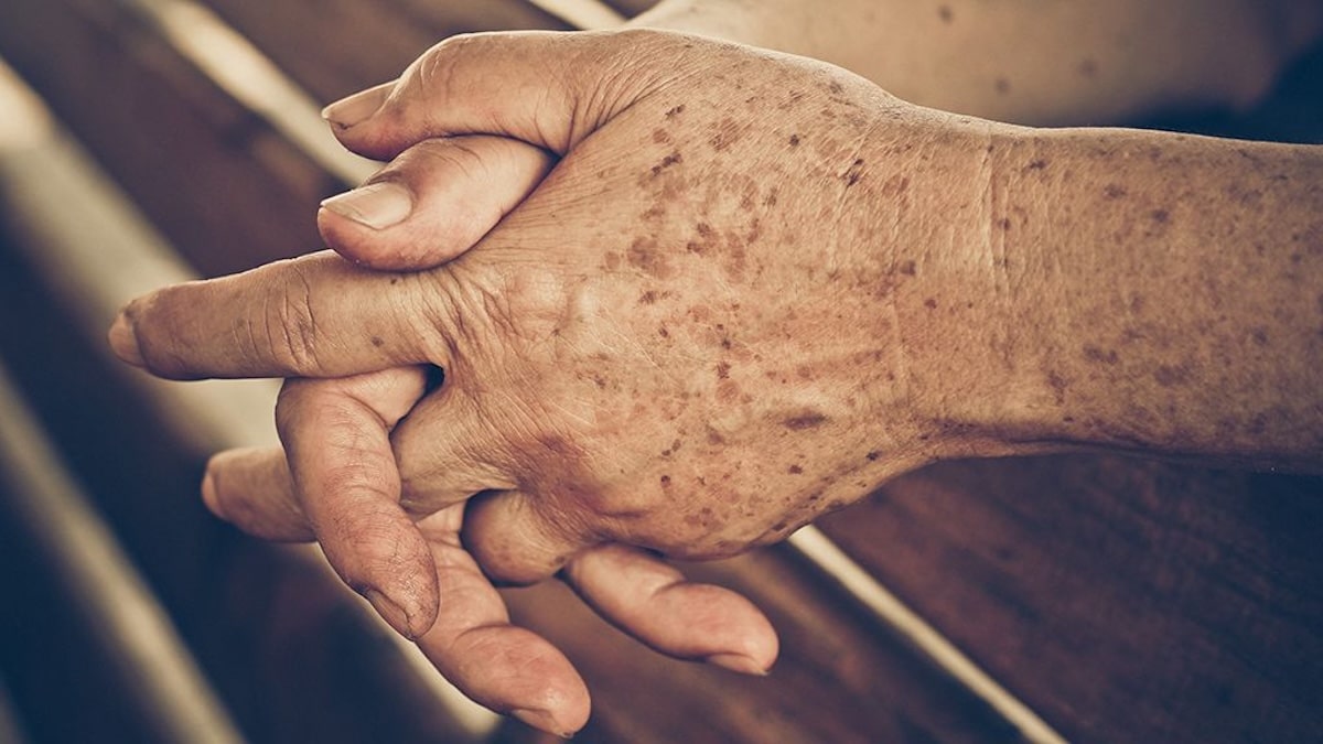 Taches sur les mains : catégories, origines et solutions
