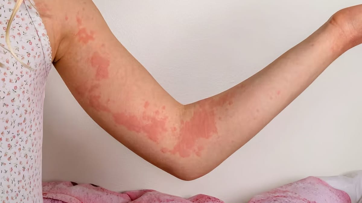 Urticaire et œdème de Quincke : diagnostic, symptômes et traitement