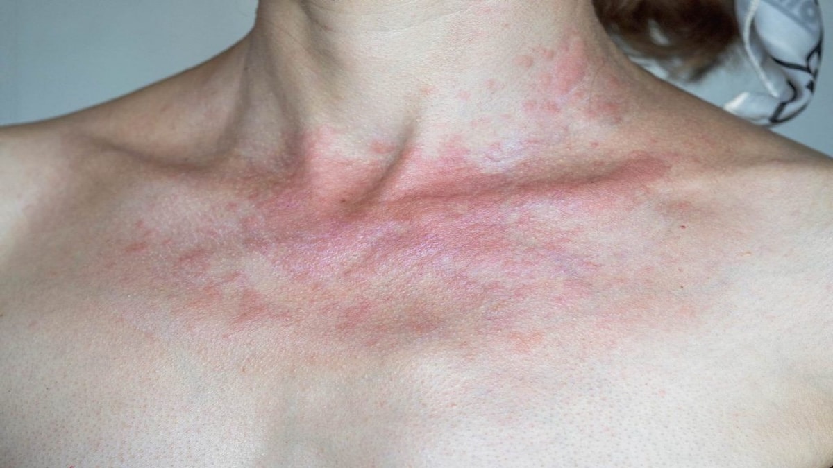 Vascularite : Signes et origines